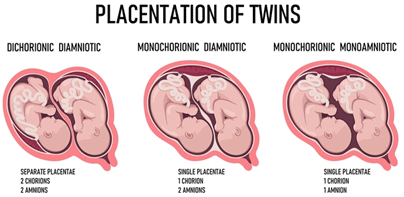 Image of the placentation of twins x 3